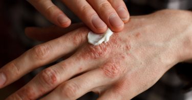 Cannabis Topical Psoriasis Treatment
