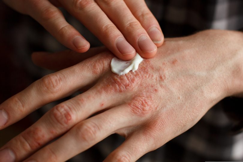 Cannabis Topical Psoriasis Treatment